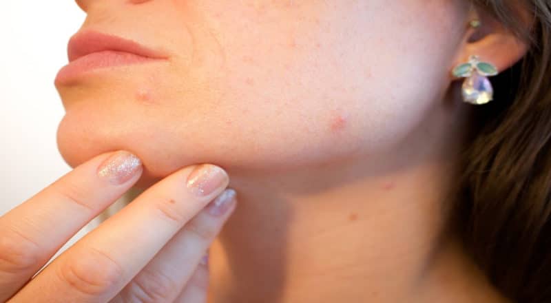 acne pimple patches